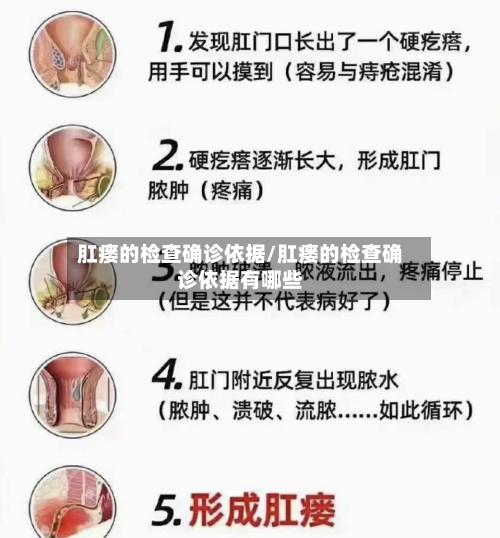 肛瘘的检查确诊依据/肛瘘的检查确诊依据有哪些