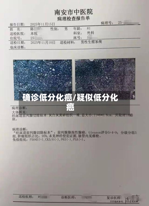 确诊低分化癌/疑似低分化癌-第2张图片