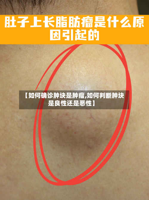 【如何确诊肿块是肿瘤,如何判断肿块是良性还是恶性】-第3张图片
