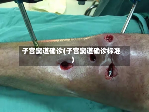 子宫窦道确诊(子宫窦道确诊标准)-第2张图片