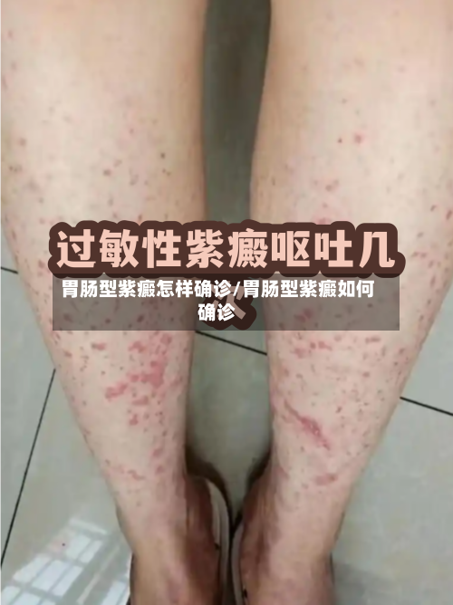 胃肠型紫癜怎样确诊/胃肠型紫癜如何确诊