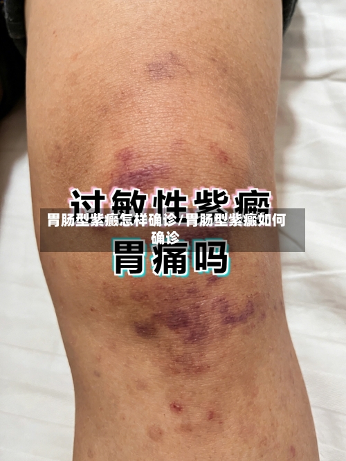 胃肠型紫癜怎样确诊/胃肠型紫癜如何确诊-第2张图片