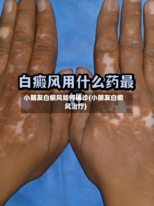 小朋友白癜风如何确诊(小朋友白癜风治疗)