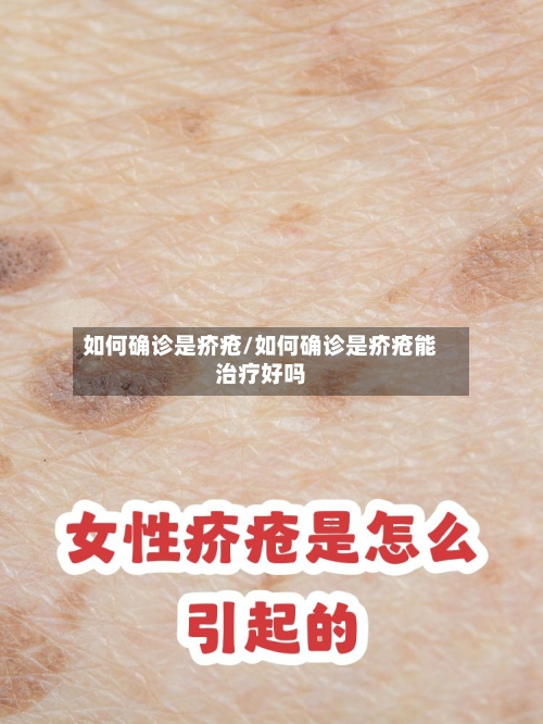 如何确诊是疥疮/如何确诊是疥疮能治疗好吗