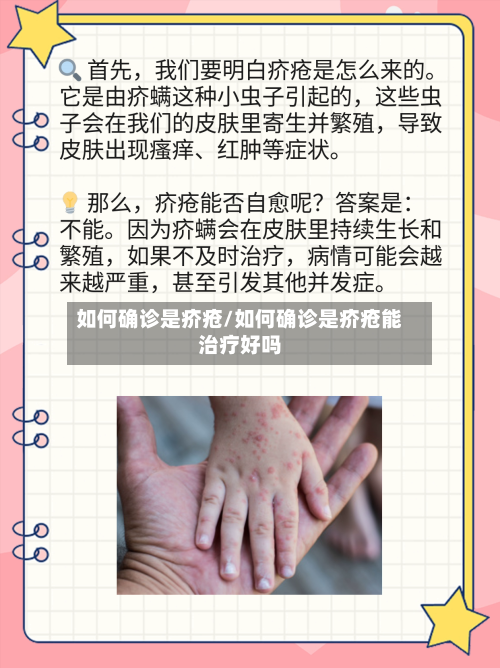 如何确诊是疥疮/如何确诊是疥疮能治疗好吗-第3张图片