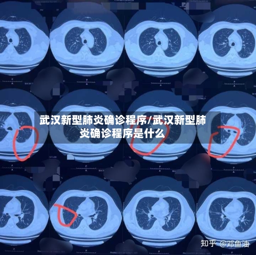 武汉新型肺炎确诊程序/武汉新型肺炎确诊程序是什么-第2张图片