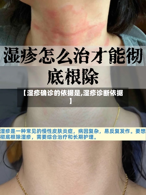 【湿疹确诊的依据是,湿疹诊断依据】