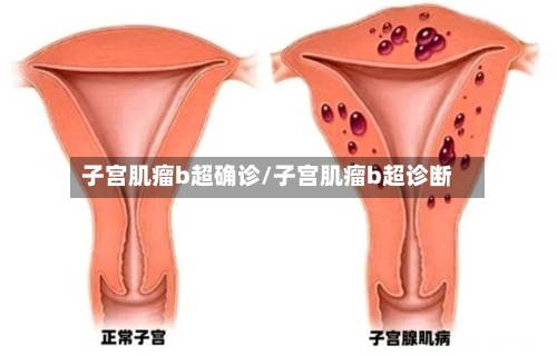 子宫肌瘤b超确诊/子宫肌瘤b超诊断-第3张图片