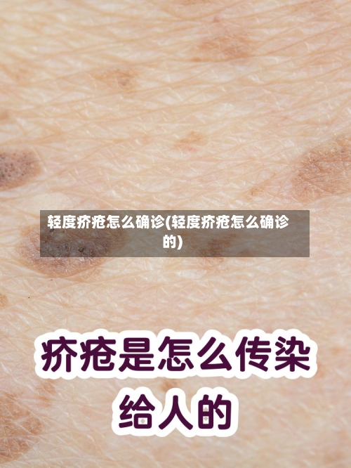 轻度疥疮怎么确诊(轻度疥疮怎么确诊的)-第2张图片