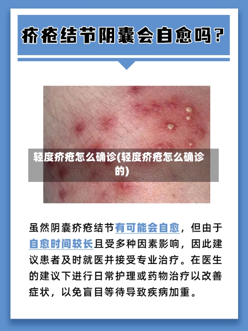 轻度疥疮怎么确诊(轻度疥疮怎么确诊的)