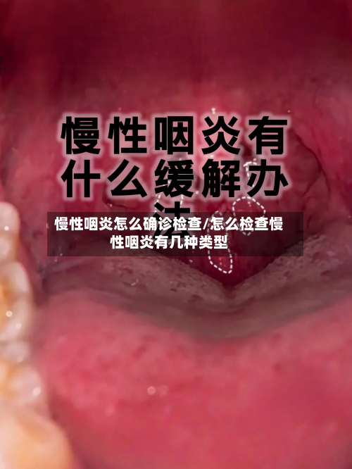 慢性咽炎怎么确诊检查/怎么检查慢性咽炎有几种类型-第2张图片