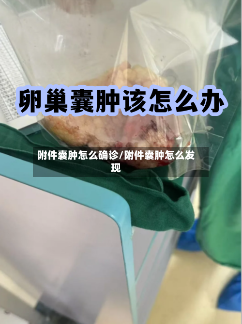 附件囊肿怎么确诊/附件囊肿怎么发现-第2张图片