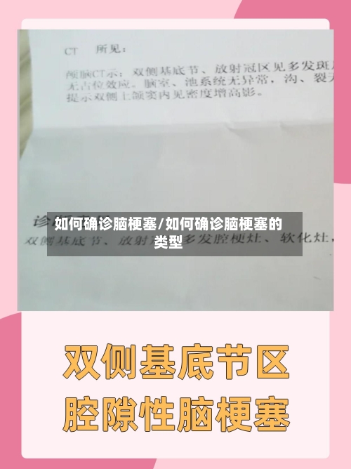 如何确诊脑梗塞/如何确诊脑梗塞的类型-第2张图片