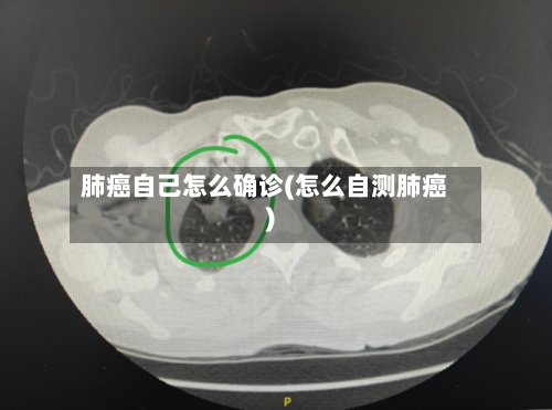 肺癌自己怎么确诊(怎么自测肺癌)-第3张图片