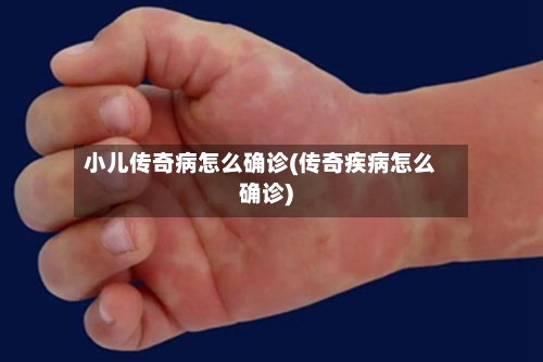小儿传奇病怎么确诊(传奇疾病怎么确诊)