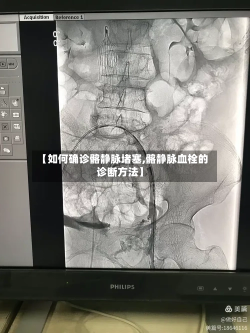 【如何确诊髂静脉堵塞,髂静脉血栓的诊断方法】