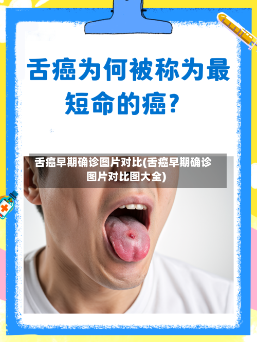 舌癌早期确诊图片对比(舌癌早期确诊图片对比图大全)-第3张图片