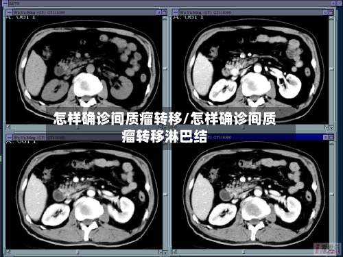 怎样确诊间质瘤转移/怎样确诊间质瘤转移淋巴结-第3张图片