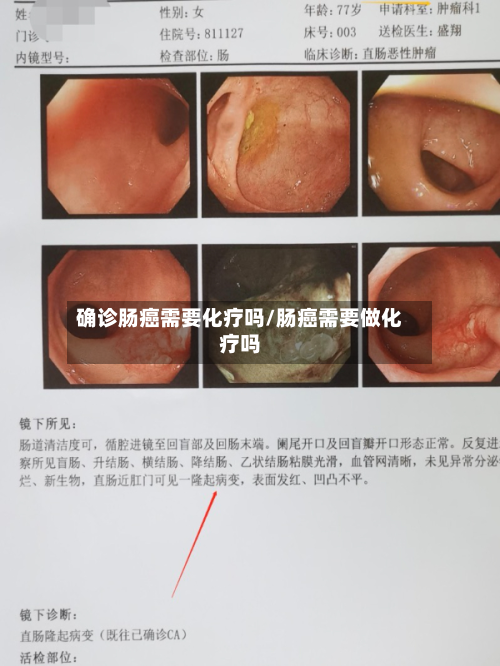 确诊肠癌需要化疗吗/肠癌需要做化疗吗-第2张图片