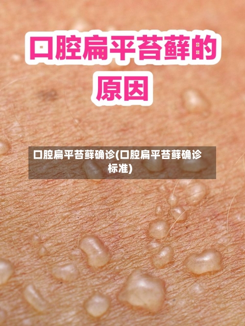 口腔扁平苔藓确诊(口腔扁平苔藓确诊标准)