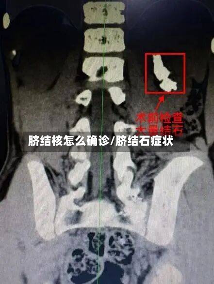 脐结核怎么确诊/脐结石症状-第2张图片