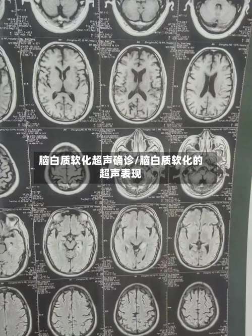脑白质软化超声确诊/脑白质软化的超声表现-第3张图片