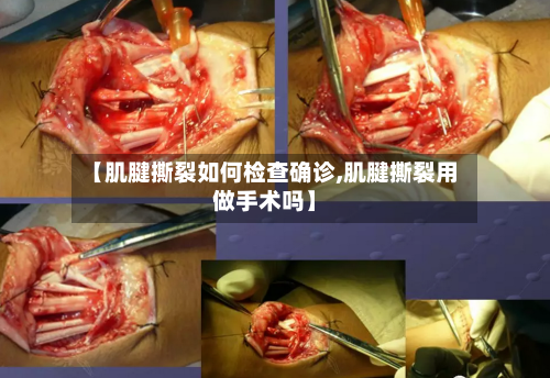 【肌腱撕裂如何检查确诊,肌腱撕裂用做手术吗】-第3张图片
