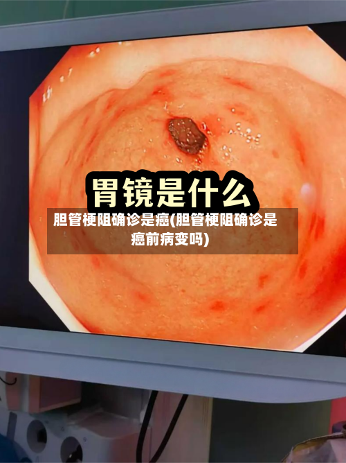 胆管梗阻确诊是癌(胆管梗阻确诊是癌前病变吗)