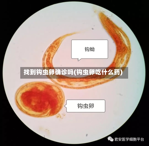 找到钩虫卵确诊吗(钩虫卵吃什么药)-第2张图片