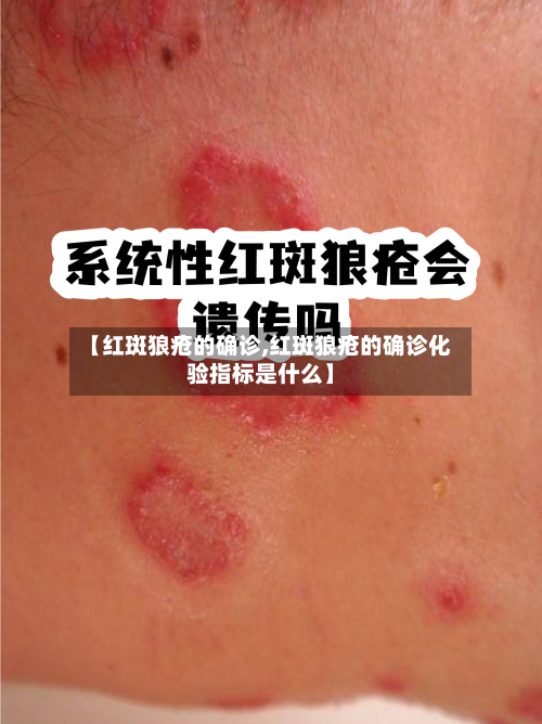 【红斑狼疮的确诊,红斑狼疮的确诊化验指标是什么】