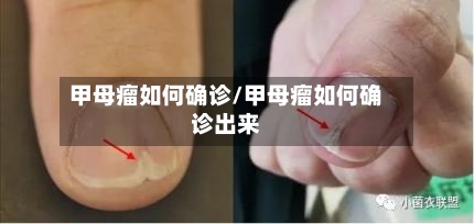甲母瘤如何确诊/甲母瘤如何确诊出来-第2张图片